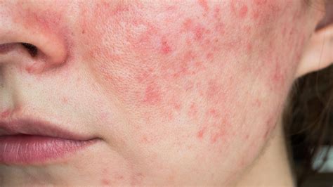 What Is Rosacea? Causes, Symptoms, Treatment, and Prevention - GoodRx