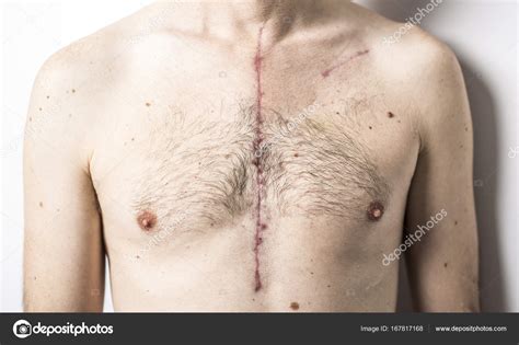 Heart Transplant Scar