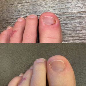 Ingrown Toenails - Surrey Foot Service