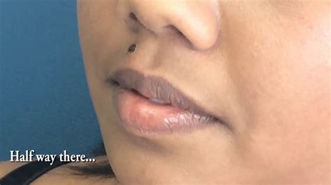 Mole Removal Right upper lip - YouTube