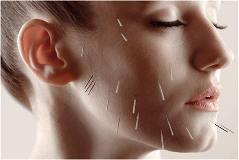 Acupuncture for Anxiety / Depression – Robina 7 Day Doctors and Acupuncture Bulk Bill