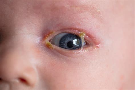 Pink Eye: Causes And How to Treat It | LaptrinhX / News