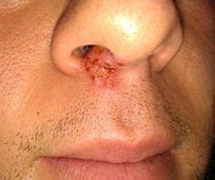 How to Treat Cold Sores Below the Nose – Coldsorescured.com | Canker sore, Cold sore, Nose sores