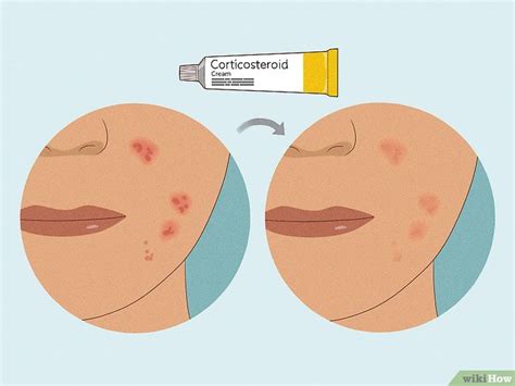 What Is Topical Steroid Withdrawal? Everything You Need to Know