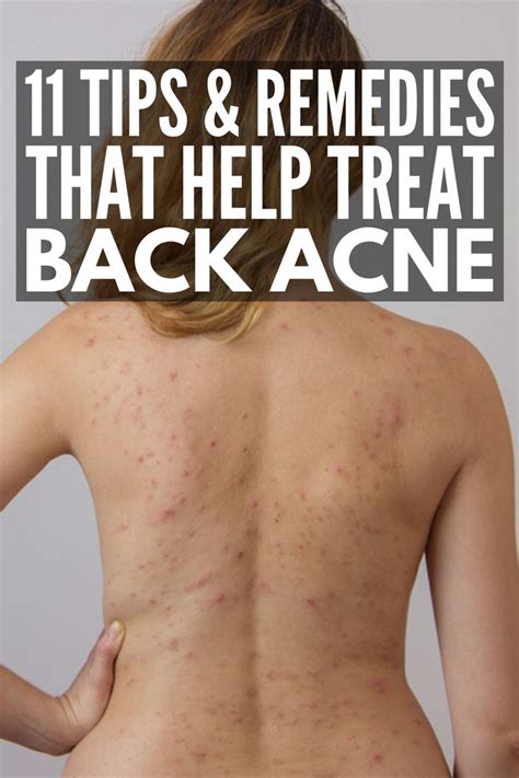 Cystic Acne Treatment, Back Acne Treatment, Natural Acne Treatment, Home Remedies For Acne ...