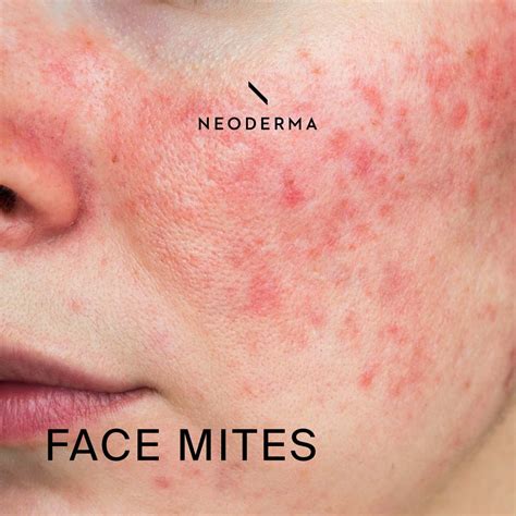 Face Mites & Demodex Mites | NEODERMA