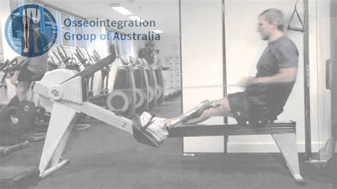 Benefits of Osseointegration - Patient Video - YouTube