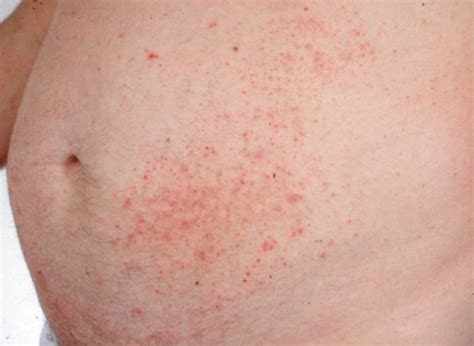 Dermatitis herpetiformis - dermRounds Dermatology Network