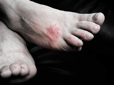 How to Recognize Psoriasis on Your Feet | Dallas Podiatry Works