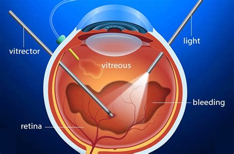 Vitreous Hemorrhage Treatment Tips - Captions Trend