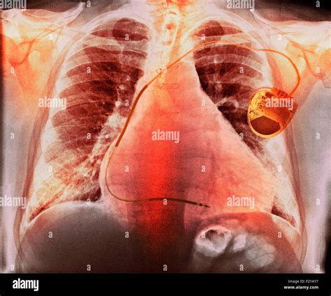 Chest x ray showing a pacemaker fitted hi-res stock photography and images - Alamy