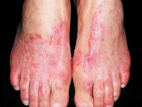 Tinea pedis, athlete's foot, causes, symptoms, diagnosis & treatment