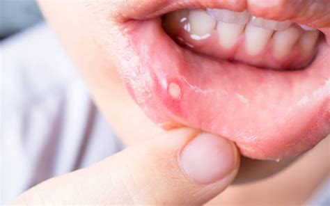 Aphthae - causes and treatment of the white blisters in the mouth - alkmene