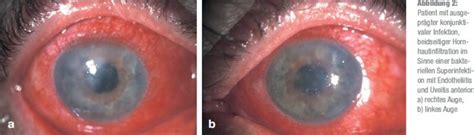 Keratokonjunktivitis epidemica