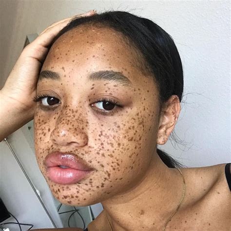 Freckles | Black freckles, Freckles, Beautiful freckles