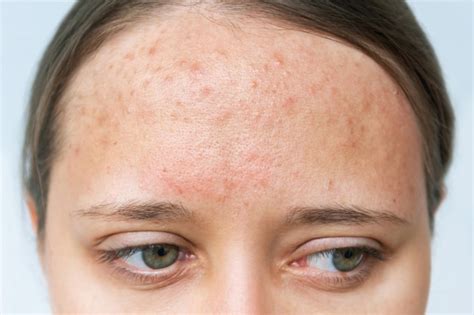 Premium Photo | Close up of red rash on a forehead. Cropped shot of a young woman's face with ...