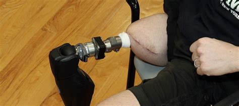 Osseointegration and A Step Ahead Prosthetics - A Step Ahead Prosthetics