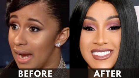 Cardi B Teeth Transformation: Surgery, Cost, Before and After