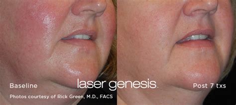 Laser Genesis - Imami Skin and Cosmetic Center