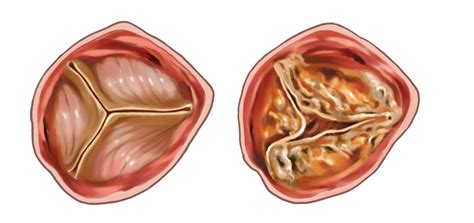 Stenosi Sintomi Stenosi Aortico Sintomi Medico Aortico Stenosi | My XXX ...