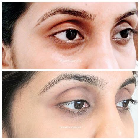 Dermal Fillers in Mumbai – Cost, Before After, Side Effects, Discount