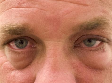 Wie werden Sie geschwollene Augen los? - DEMedBook