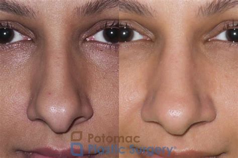 Septoplasty And Turbinate Reduction Before And After