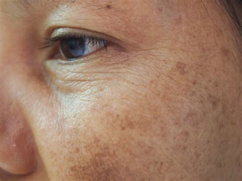 What Causes Skin Pigmentation? How to Remove It?