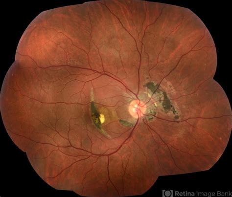 Traumatic Choroidal Rupture - Retina Image Bank