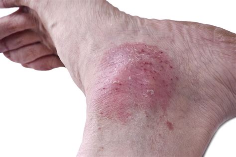 Skin Rashes On Feet