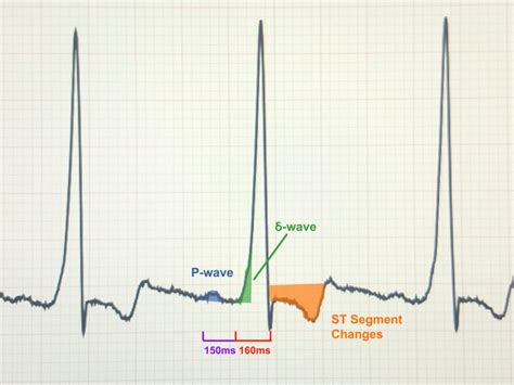 Wolff Parkinson White Syndrome - Causes, Symptoms, Treatment