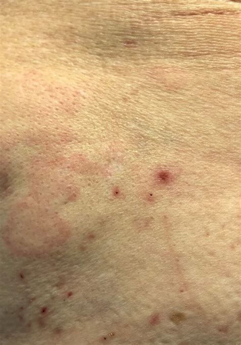 Erythematous Plaques- Clinical Advisor