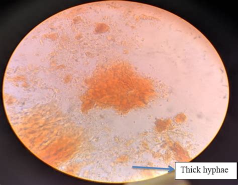 Eumycetoma infection of the hand: A case report - IJMMTD