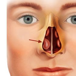 Septum And Turbinate Surgery