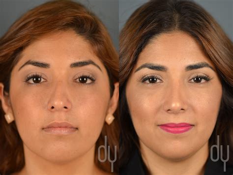 Rhinoplasty | Nose job Before and After Recovery Experience – Beverly Hills | Beverly Hills ...