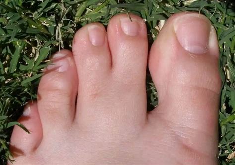 Webbed toes - Treat n Heal