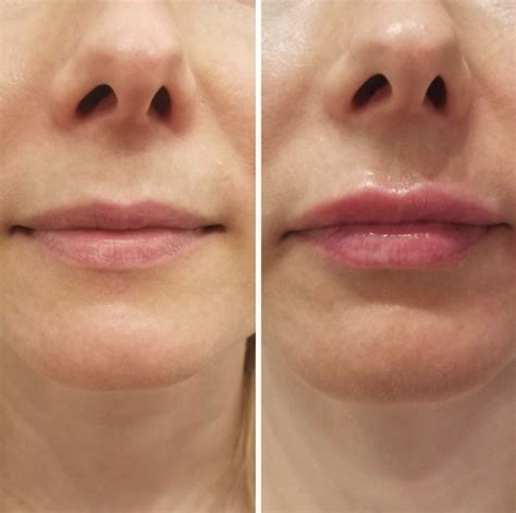 What’s the Difference between a Lip Flip vs Lip Fillers? | EA San Diego
