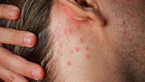 Le psoriasis: comment non pas guérir mais apprendre à vivre avec ...