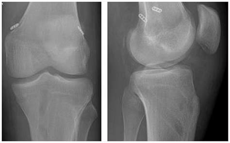 Radiographs after simultaneous ACL and PCL reconstruction. | Download ...