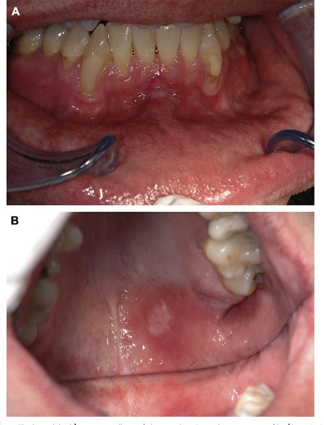 Figure 1 from Oral syphilis: a series of 5 cases. | Semantic Scholar