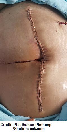 How to Remove Surgical Staples