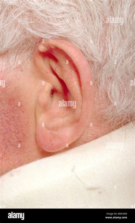 Chronic tophaceous gout Stock Photo - Alamy