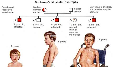Learn about Duchenne muscular dystrophy. What are causes in 2021 | Duchenne muscular dystrophy ...