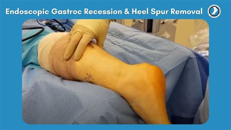 Endoscopic Gastroc Recession and Heel Spur Removal - YouTube