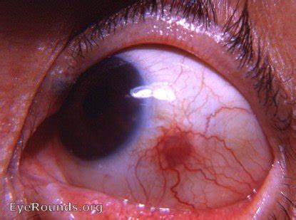 Nodular episcleritis. EyeRounds.org: Online Ophthalmic Atlas