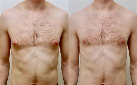 Gynecomastia Before After Gallery, 54% OFF