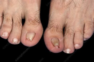 Pincer nail deformity - Stock Image - C050/9909 - Science Photo Library