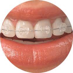 Braces Clip, Clear, Orthodontic Transparent