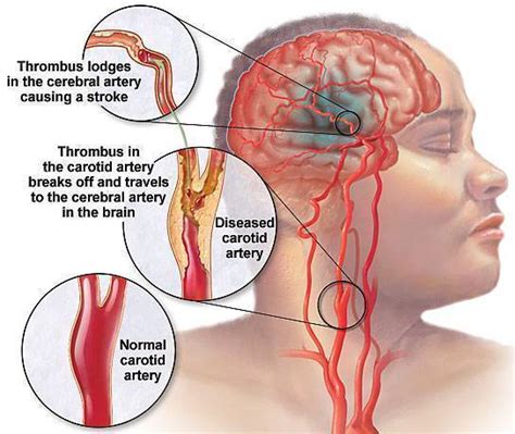 Symptoms of Blocked Carotid Artery – Medical Symptoms Guide