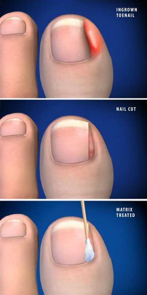 Partial Nail Avulsion Post Surgery - Nail Ftempo